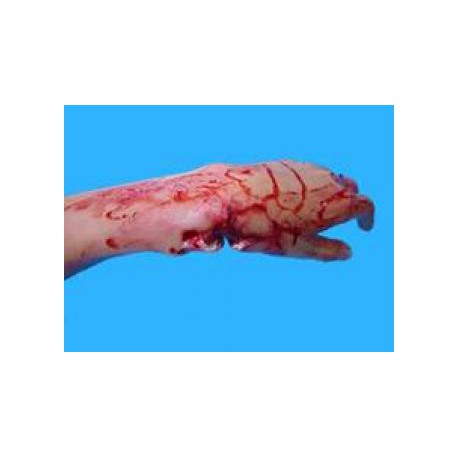 Fracture ouverte du poignet