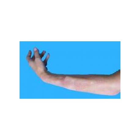 Fracture interne avant bras, tibia ou clavicule